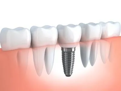 model of a dental implant being placed